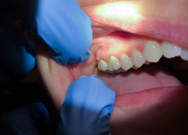Best Emergency Broken Tooth Repair in Forsyth, MO