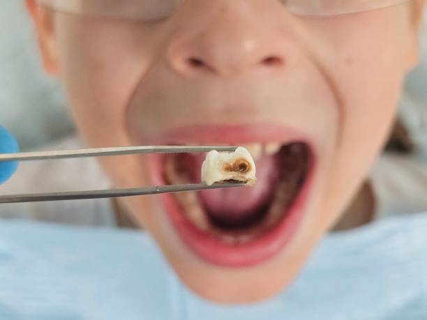 Best Emergency Treatment for Toothache in Forsyth, MO
